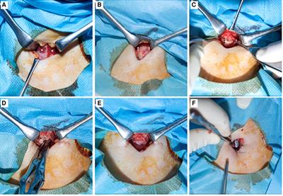 Cricotracheostomy for patients with severe COVID-19: A case control study